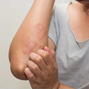 EXÁMENES PREVENTIVOS ALERGIAS